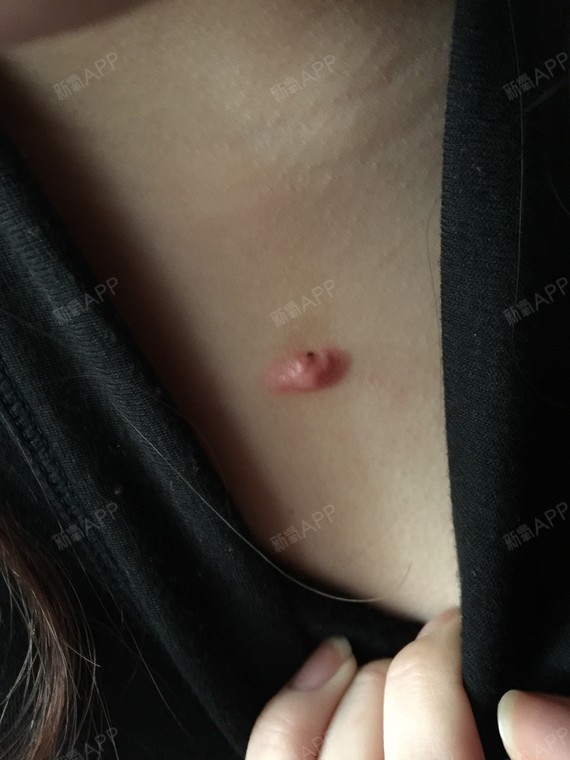 医生,我不确定我是疤痕体质(前几年腋下做过手术,后_圈子-新氧美容