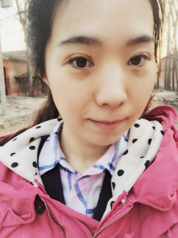 埋线双眼皮