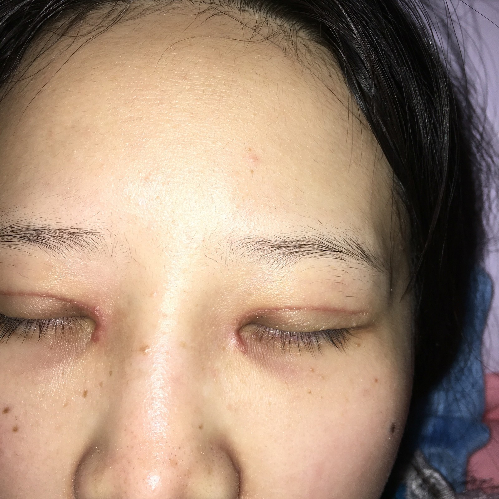 双眼皮全切加开内眼角一个月了,眼角处疤痕明显怎么办?是不是增生了?