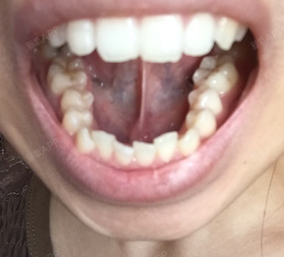 门牙有点突,下牙拥挤导致嘴突,且疑似深覆合,下