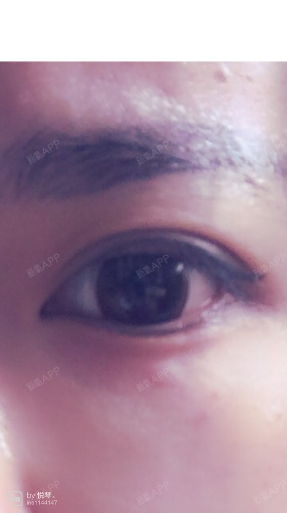 首页 此页面仅支持预览 Avatar Biubiuk 7篇日记 切开双眼皮项目术后第2天 有一边眼袋肿出来了 好恼火 就是多打麻药的那边 真的该全麻 哎哎哎 编辑于16年2月 合集 切开双眼皮共5篇 术后第0天 严重肿胀期 第1篇日记 术后第1天 严重肿胀期 第2篇日记 术