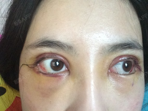 开外眼角好不好_效果图_旧梦酒浓开外眼角术后第2天_新氧美容整形