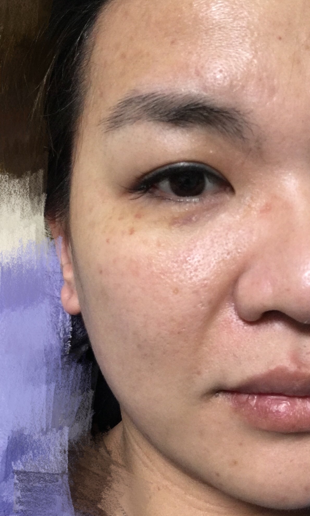 新氧- 筱米 | 术后当自强 | 上海同城 | 水光针 | 激光美肤 | 改善