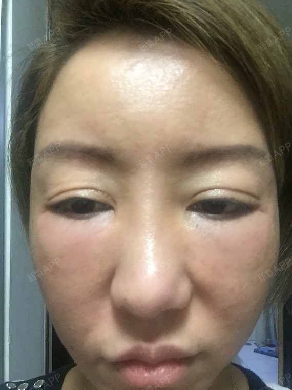 玻尿酸失败 想打溶解酶 额头打了6支 想打溶解酶 能一次溶掉么 会不会
