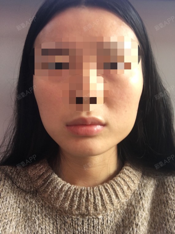 下颌角宽大,面部不对称,应该还有咬肌.