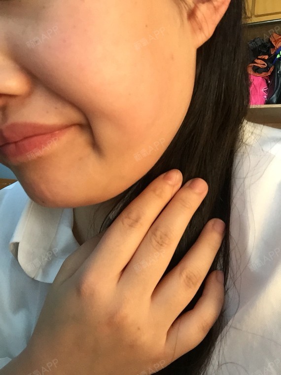 从小到大都是u型脸,现在产后胖了不少,脸变得更大了_圈子-新氧美容