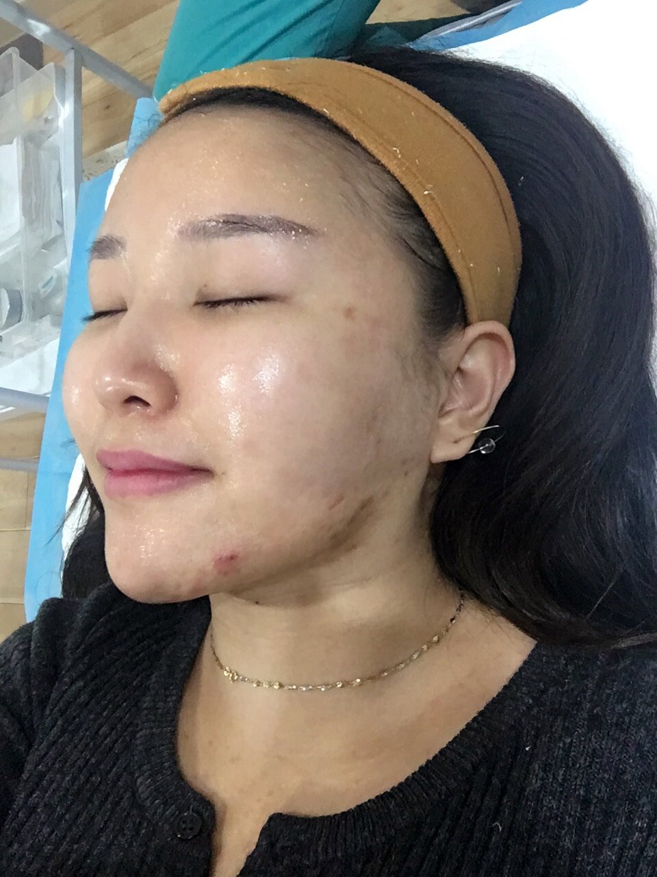 新氧- 小阿肥肥fei | 术后当自强 | 北京同城 | 果酸换肤 | 激光美肤