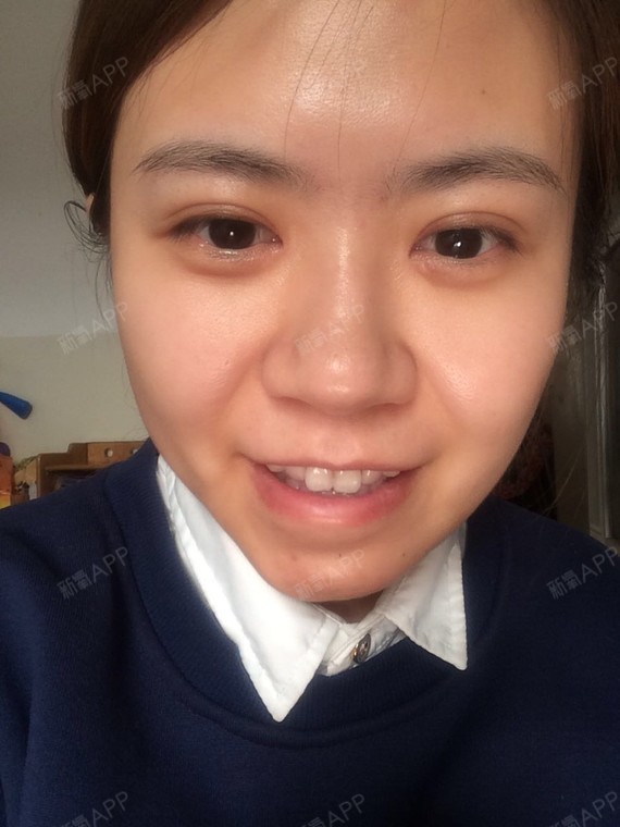 双眼皮很明显一宽一窄内眼角开的也不好,硅胶垫的下巴,一笑就歪,崩溃