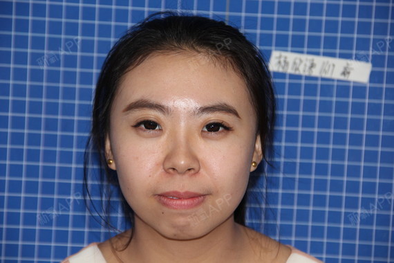 没下巴,就注定会被人说成是方脸,国字脸,短下巴的你_圈子-新氧美容