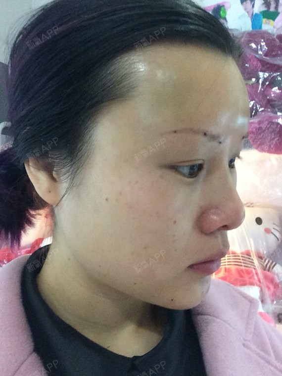 额头有点凹凸不平的,不知道是不是没消肿的原因!