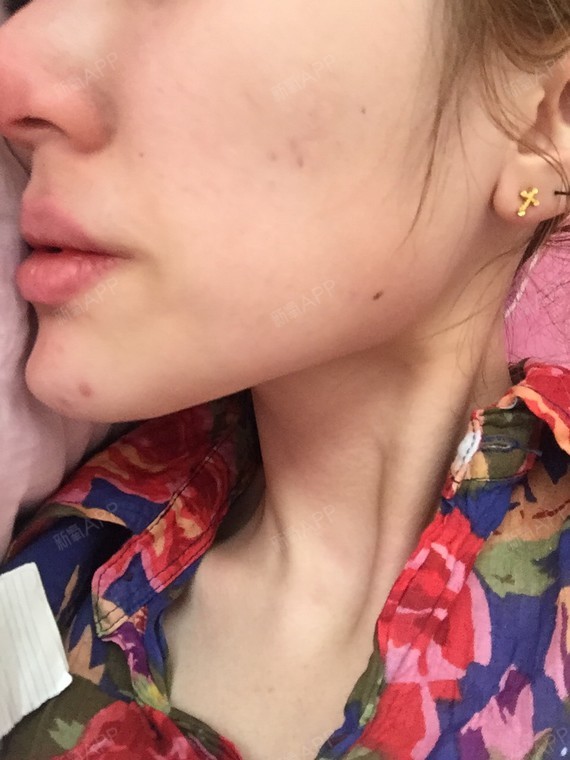 我摸着下颌角那里是有肉的,不过别人说是骨头,请问