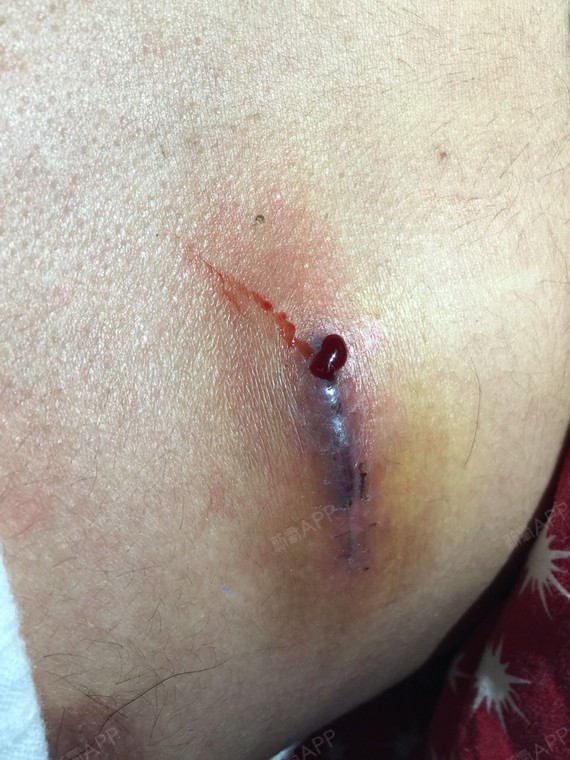 我因为鼻中隔软骨没有,医生用我的肋软骨撑_圈子-新氧美容整形