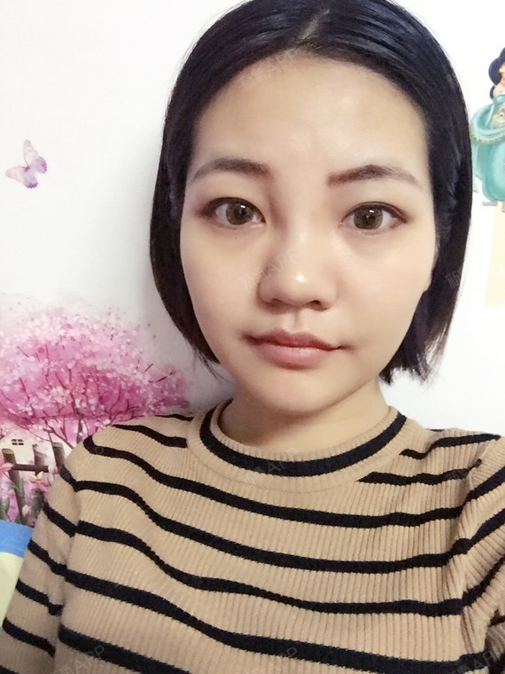 作为一个身高165cm,体重44kg的瘦子,我的脸_圈子-新氧美容整形