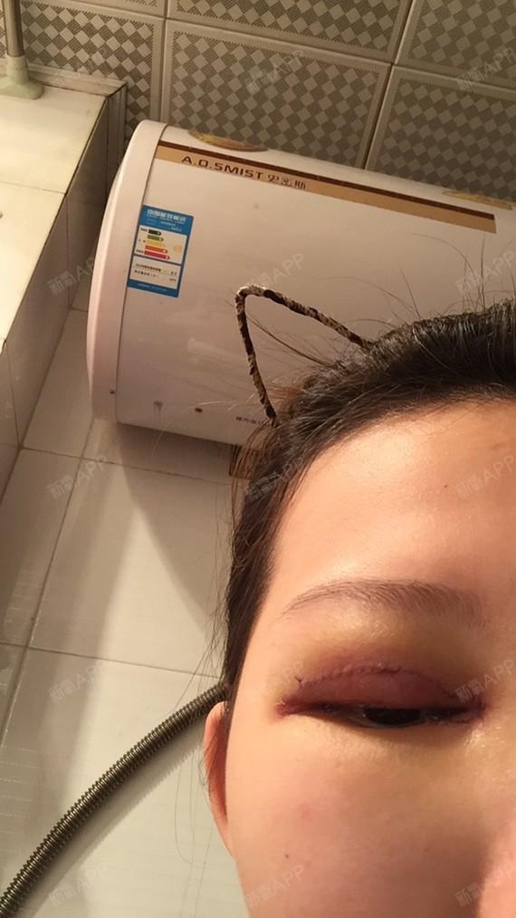 新氧- 皮扒啵 | 眼部 | 开眼角 | 双眼皮 | 开内眼角 | 切开双眼皮