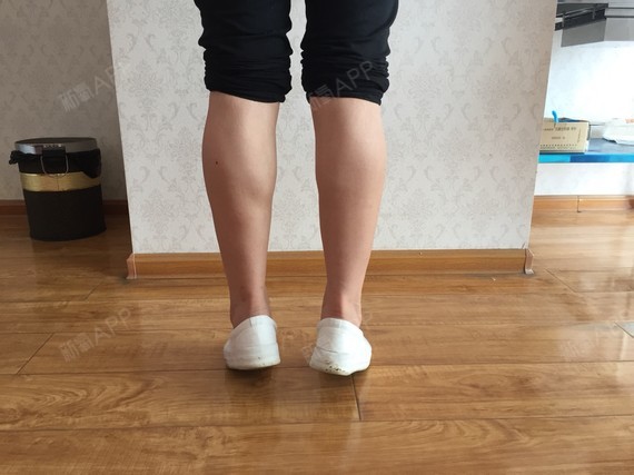 一直觉得小腿肌肉挺线条不是很满意,外侧线条比较肥大_圈子-新氧美容