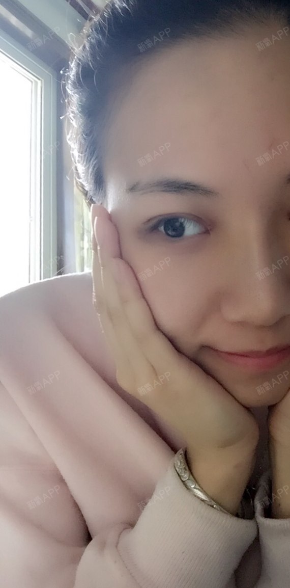 全切双眼皮恢复了八天半的我太不容易了之前和鬼一样.