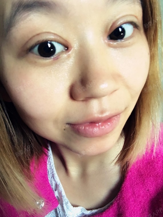 眼角很明显肉比较突出,不知道是不是增生了.