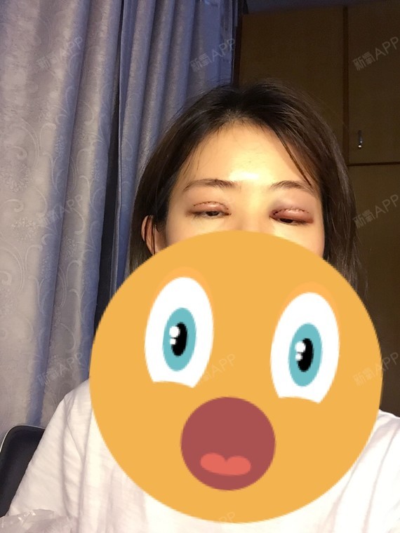 自己拆下纱布的这两只眼睛好像非常不对称图三是晚上很_圈子-新氧美容