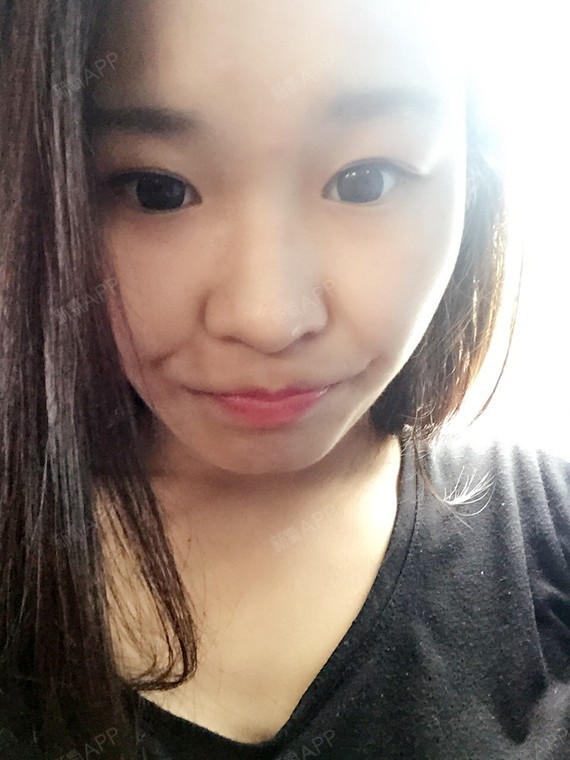 daisy小悦悦肉毒素瘦脸第121天美丽日记