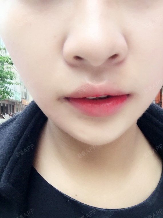 daisy小悦悦第121天美丽日记-新氧美容整形