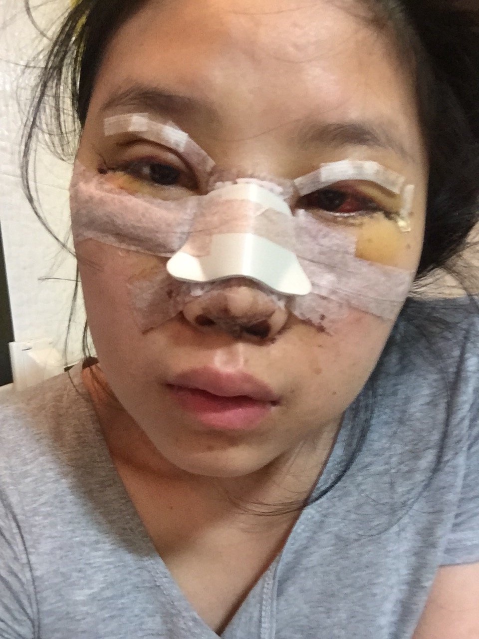 不知道为啥脸也这么肿,对了,我请问问,在这边手术完你们去哪吃东西