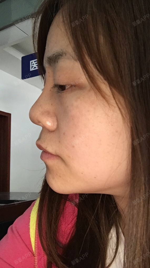 严重漏鼻孔!鼻翼肥厚!鼻子毁所有_圈子-新氧美容整形