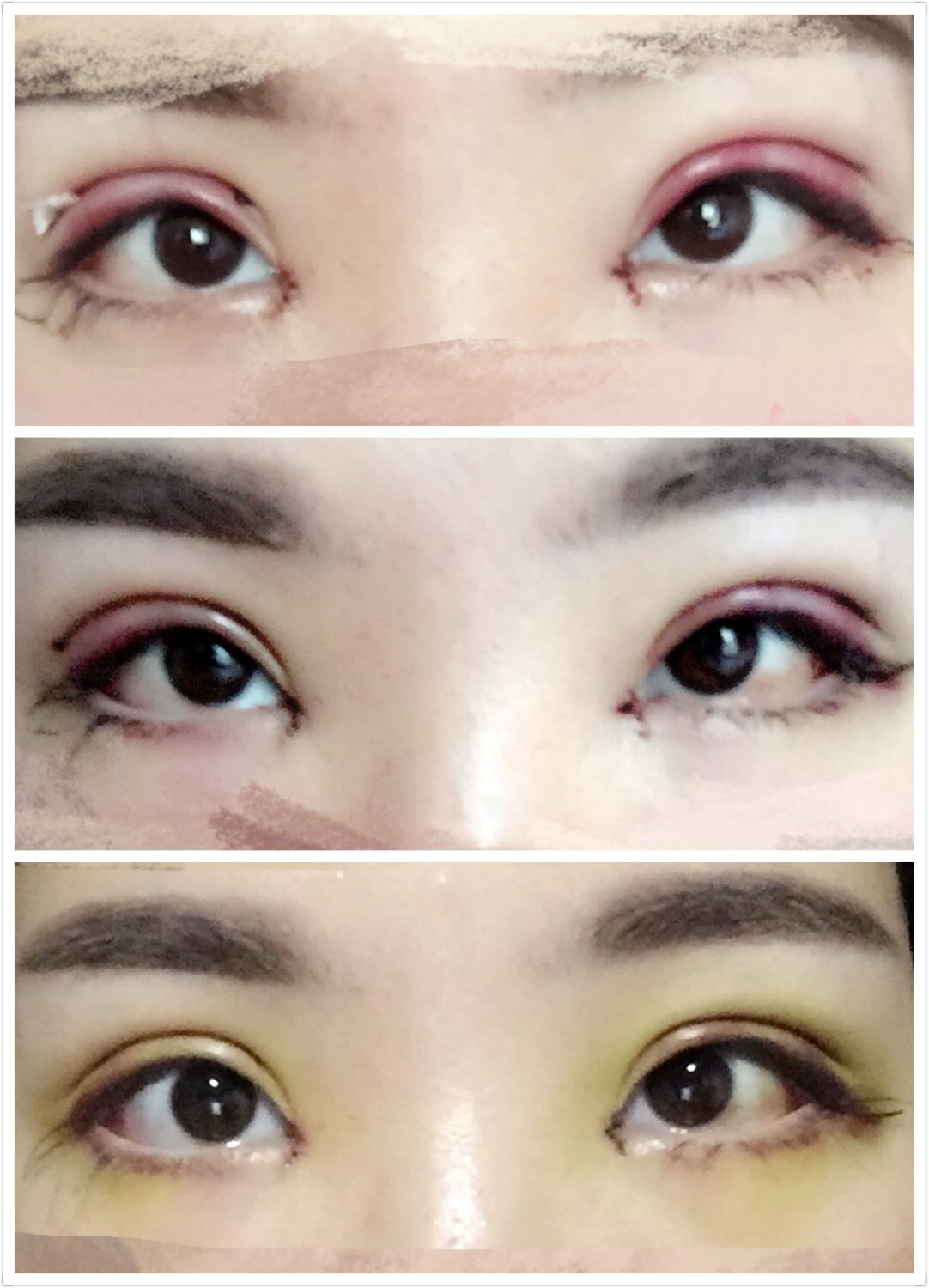 miffy_tu开内眼角第1天美丽日记-新氧美容整形