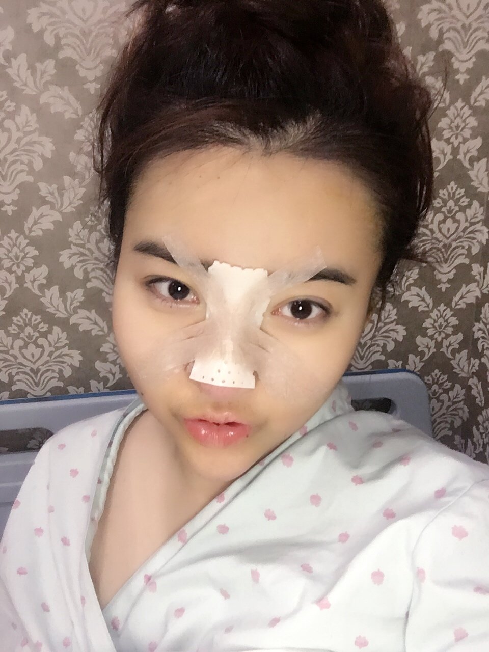 耳软骨复合隆鼻怎么样_恢复过程_效果如何_氧气_lulmae3af整形日记5.