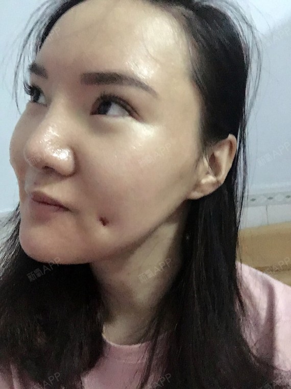 成形术好不好_效果图_叮当猫的眼泪酒窝成形术术后第天_新氧美容整形