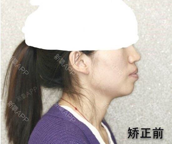 我上颌有点外凸,像图片,谁有在韩国做过正颌手术,推荐下医院!