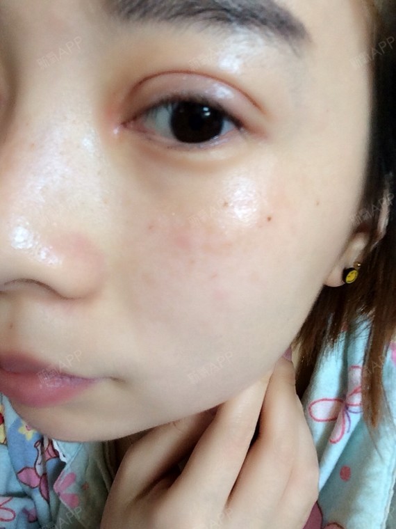 眼角伤口一直红是怎么回事 25天了 会不会感染了 现在偶尔会疼