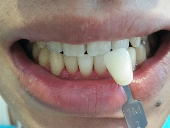 啵啵9292冷光美白第0天美丽日记-新氧美容整形