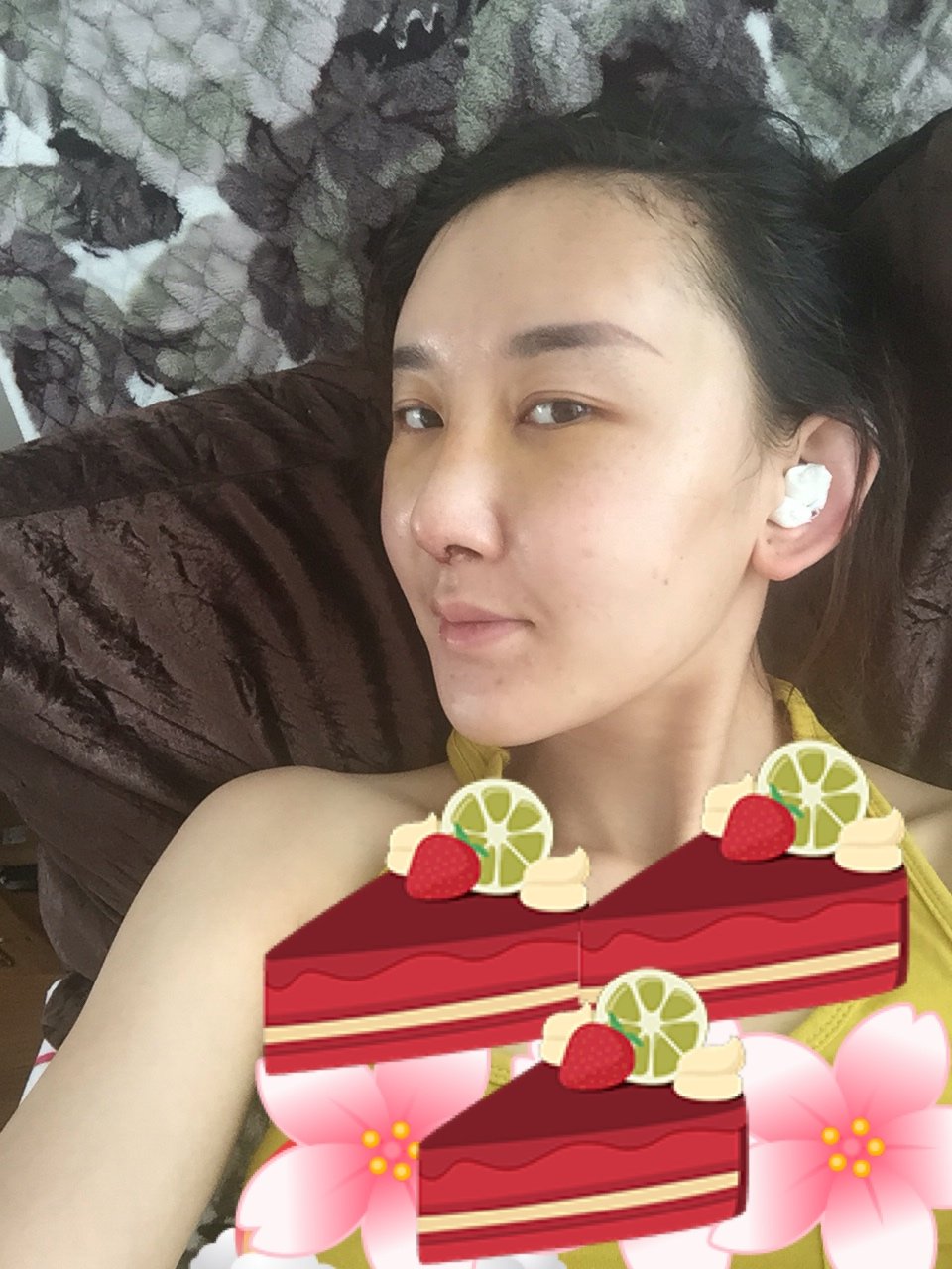 耳软骨复合隆鼻怎么样_恢复过程_效果如何_周怡帆整形日记5.