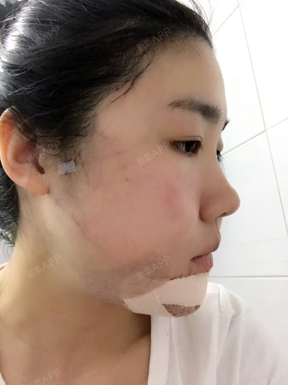 颧骨内推好不好_效果图_浴凰颧骨内推术后第3天_新氧美容整形