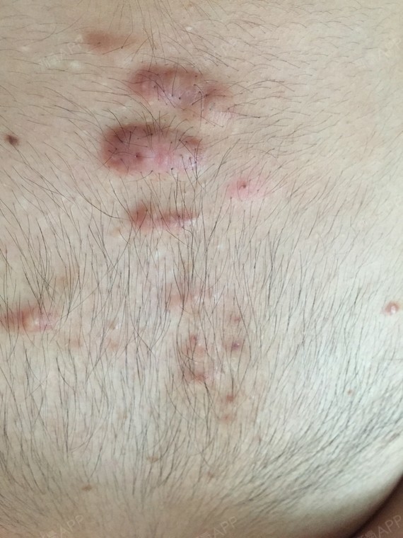 各位好,我大一的时候胸口长了一颗痤疮,后来逐渐变成_圈子-新氧美容