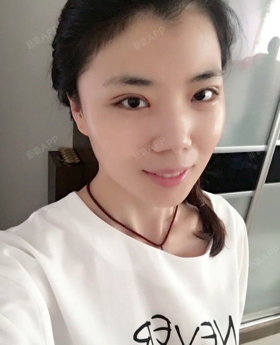 全切双眼皮
