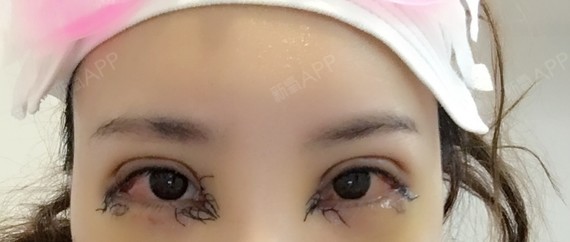 连我妈都认不出是我了～以前吊眼梢很厉害,看起来_圈子-新氧美容整形