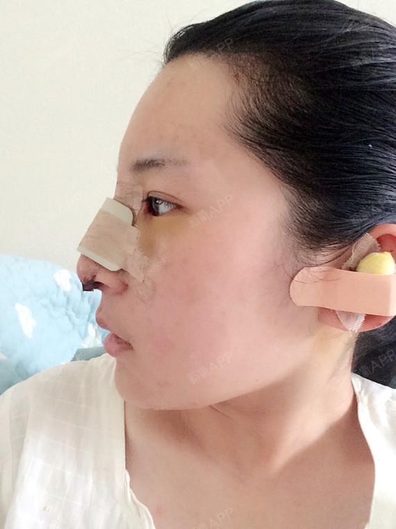 耳朵上包的纱布可能是_圈子-新氧美容整形