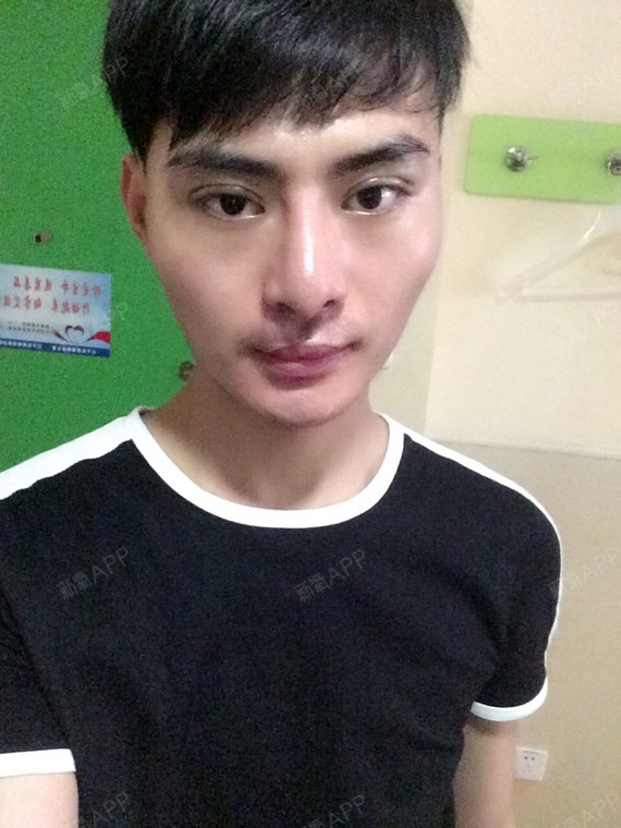 埋线双眼皮好不好_效果图_王晨雨埋线双眼皮术后第0天_新氧美容整形