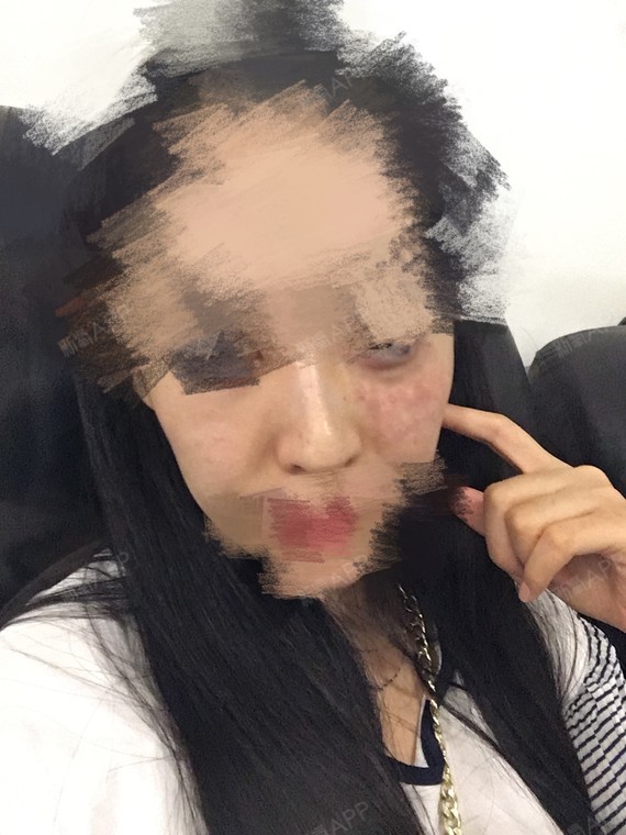 今天打完苹果肌一侧脸出现红斑凹凸不平很明显是正常的 圈子 新氧美容整形
