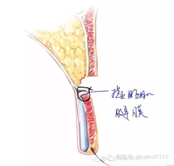 因为这是眼睑的解剖结构所决定的,不是靠外部力量所能改变的.