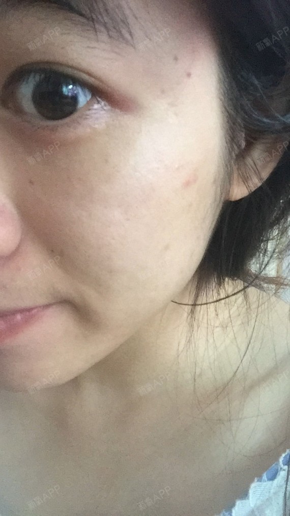 今天是打了水光针后第三天,针眼和红肿什么已经几乎全_圈子-新氧美容