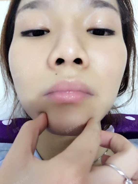下巴歪了怎么办…虽然不是很明显但是自己完全摸得到啊_圈子-新氧美容
