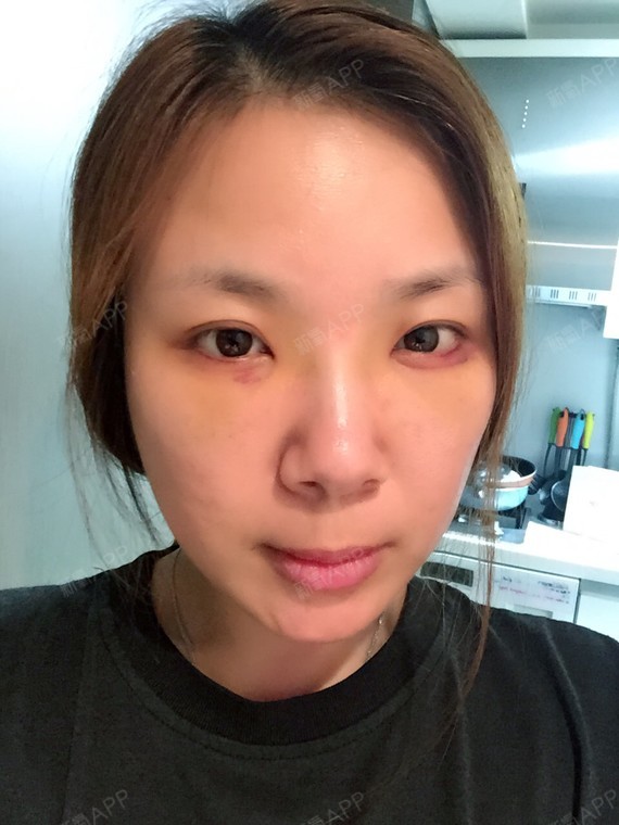 手术后第三天,今天拆线了,一点也不疼,也做了下消肿管理,比之