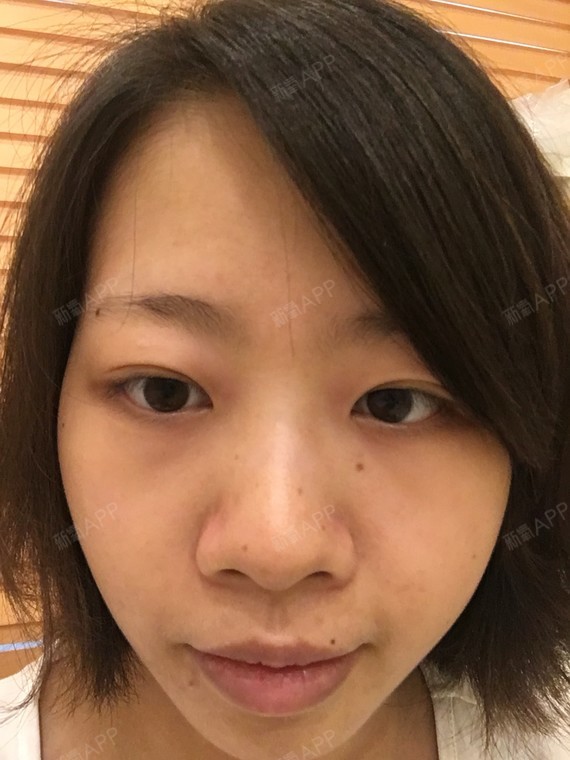 快三个月了,三层眼皮的烦恼没有了,真好