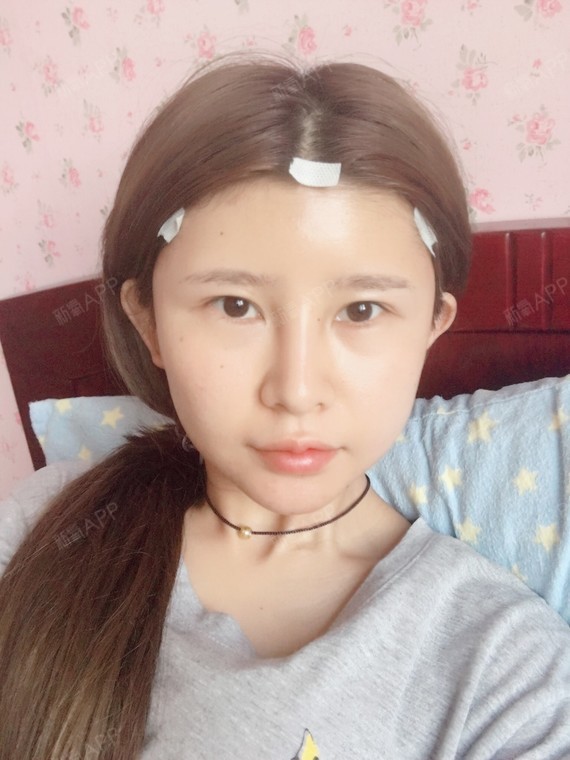 昨天去把下巴溶掉了一下子脸型就变了感觉没了下巴之后_圈子-新氧美容