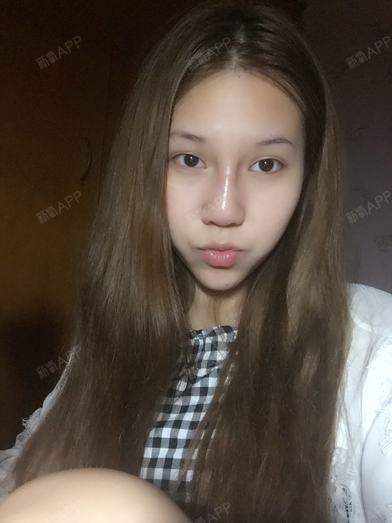 这是第二次打玻尿酸在鼻子了鼻子在2015的10月份_圈子-新氧美容整形