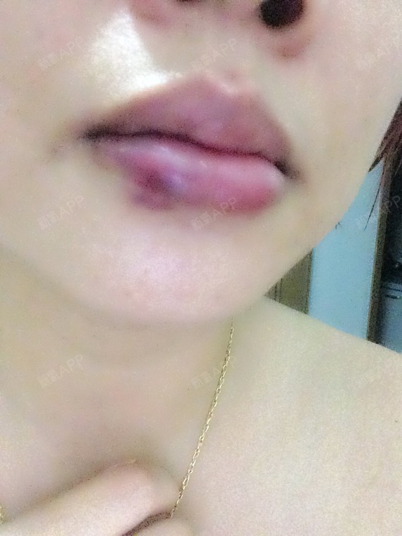 玻尿酸丰唇,肿了,紫黑的!这是栓塞吗?好怕,谁能帮_圈子-新氧美容整形