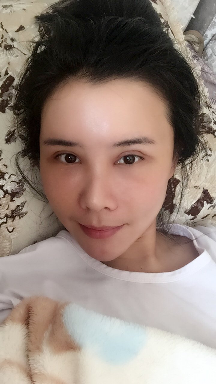 我眼睛切了两个月了,大小眼能修复芭比眼吗