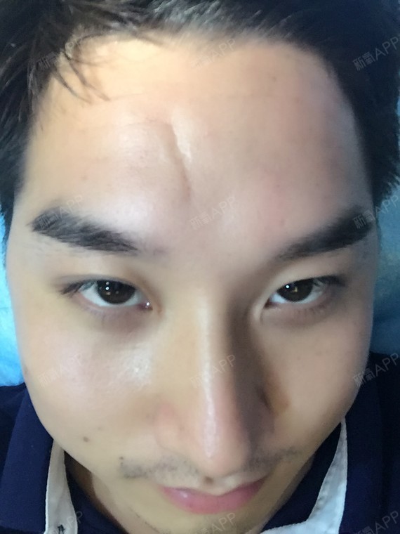 额头的疤痕是小时候调皮留下的,现在有20多年了,一_圈子-新氧美容整形